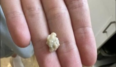 Here’s What You Need to Know About Tonsil Stones