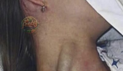 Massive Jugular Distension: A Warning Sign You Shouldn’t Ignore