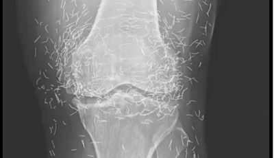 X-Ray Reveals Hundreds of Gold Needles in Woman’s Knees