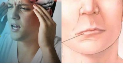 A Sign of Stroke May Occur 90 Days in Advance