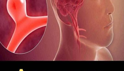 12 Signs That May Signal a Brain Aneurysm — Don’t Ignore Them (Early Recognition Could Save Your Life)