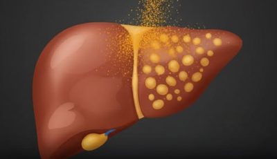 One Teaspoon a Day May Help Reverse Fatty Liver—Naturally