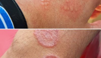 Signs of Groin Skin Irritation: Causes, Symptoms, and Gentle Care
