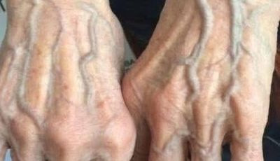 When to Worry About Veins That Appear Out of Nowhere!?