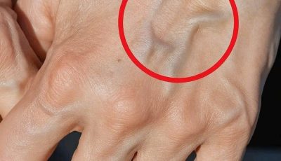 Visible Veins What They Mean and Why You Might See Them