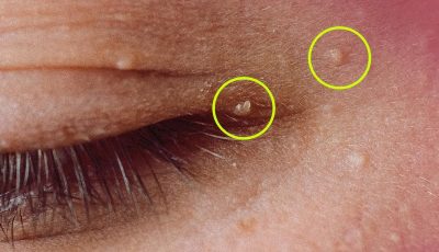 How to Get Rid of Milia: Those Annoying Fat Cysts