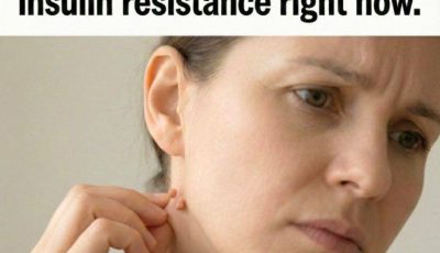 These 5 visible clues reveal insulin resistance long before blood tests