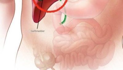 What happens to the body after gallbladder removal? 3 possible complications