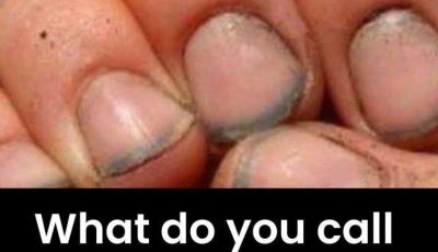 What do you call a person who has nails like that?