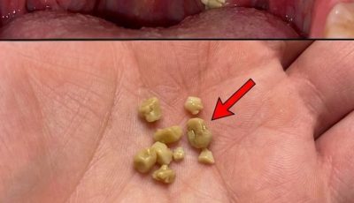 Tonsil Stones: What They Are, How to Remove Them Safely, and Why “Forever” Isn’t Realistic (But Relief Is!)