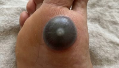 A Painful Spot + Inability to Move the Foot — This Requires Prompt Medical Evaluation (Here’s Why)