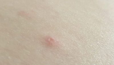 How to Identify Common Bug Bites — What’s Harmless vs. When to Seek Help