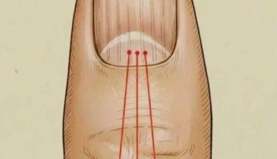 Nail Ridges and Nutrition — What Science Actually Says (Beyond the Hype)