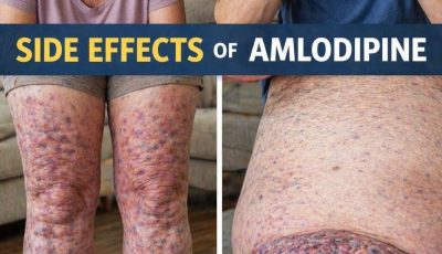 The 12 main side effects of amlodipine (that doctors never mention
