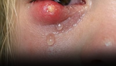 A Sudden Lump on Your Child’s Eyelid? Here’s What It Could Be—and What Parents Should Do