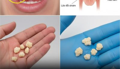 Here’s What You Need to Know About Tonsil Stones
