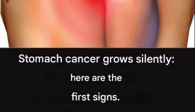 Stomach cancer grows silently: here are the first signs!