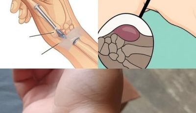 The Healing Power of Castor Leaves
