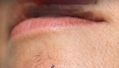 How stress and diet affect chin hair growth in women.