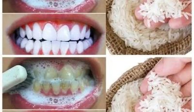 RAPID TEETH WHITENING in 1 Minute!