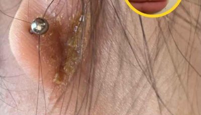 If you have scabs behind your ears, it definitely means you have…See More