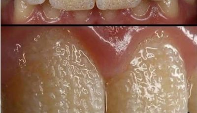 The Hidden Danger Destroying Your Smile That Your Dentist Might Have Missed Until Now