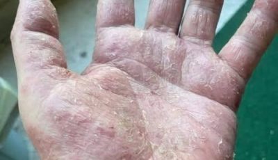Hand Dermatitis: Symptoms, Causes & How to Find Relief