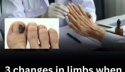These 3 Changes in Your Arms or Legs Could Be Early Warning Signs of Can.cer