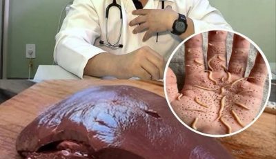 Doctors reveal that eating beef liver can cause.