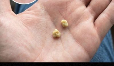 Gallstones: What are they and how are they removed?